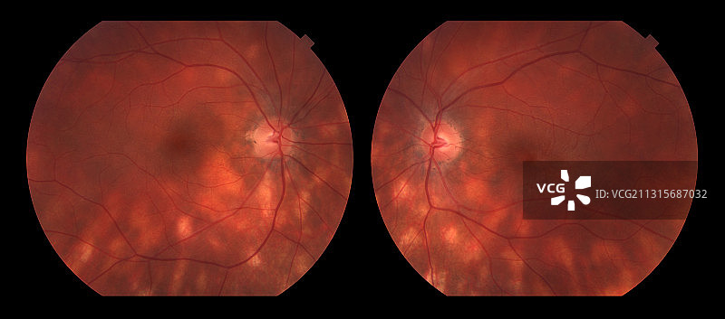 鸟枪状脉络视网膜病变图片素材