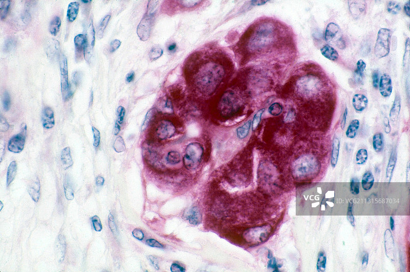 癌，LM图片素材
