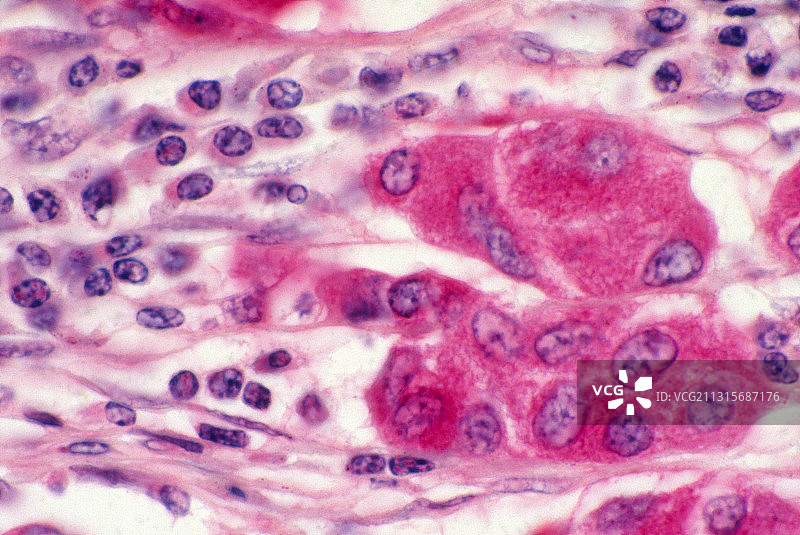 乳腺癌图片素材