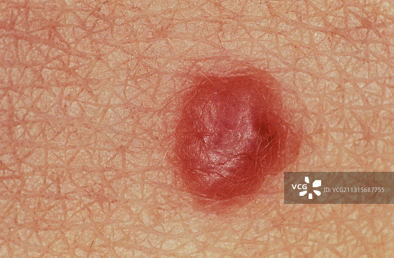 青少年黑色素瘤图片素材