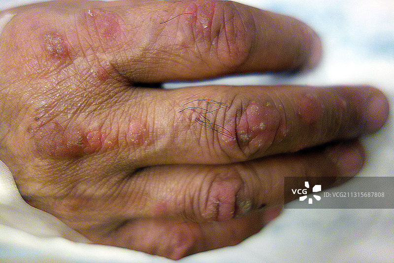 牛皮癣图片素材