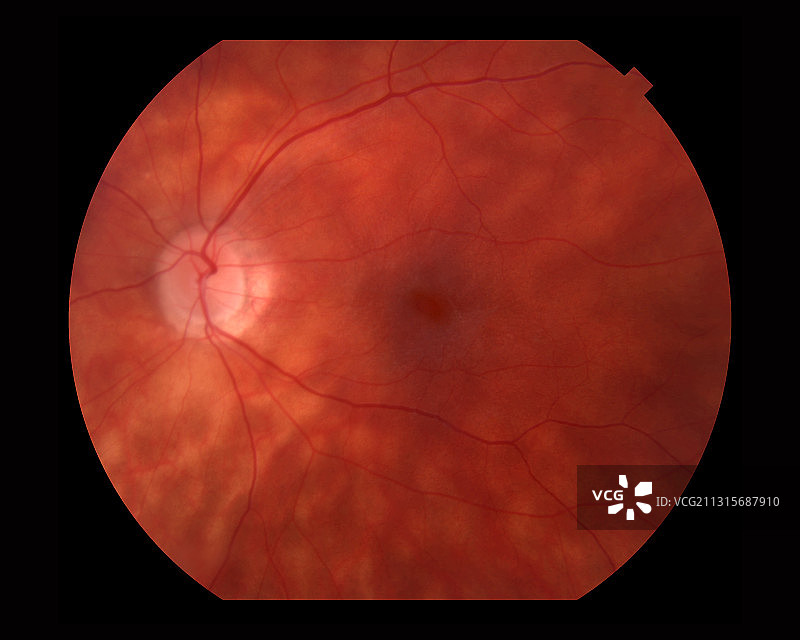 鸟枪状脉络视网膜病变图片素材