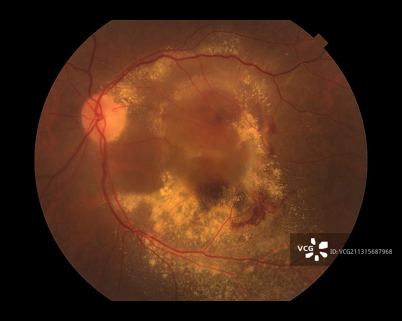 湿性老年黄斑变性图片素材
