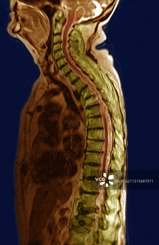 腰椎压缩性骨折，MRI图片素材