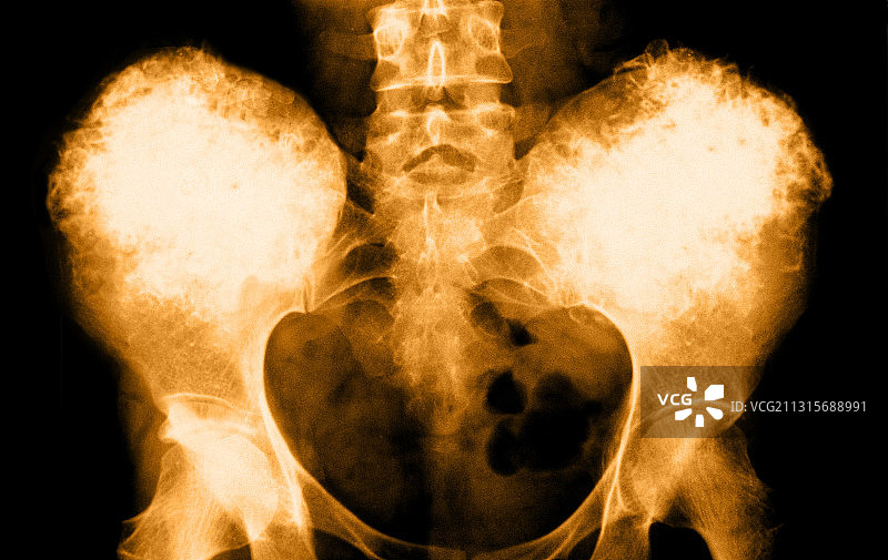 骨质疏松症图片素材