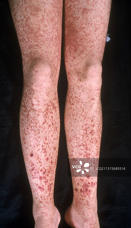 血管炎图片素材