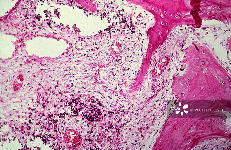 尤文氏肉瘤图片素材