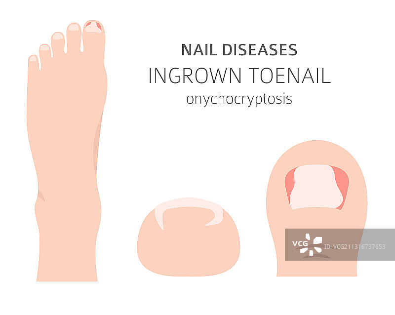 甲沟炎等指甲疾病图片素材
