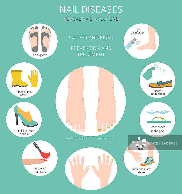 甲癣指甲真菌感染图片素材