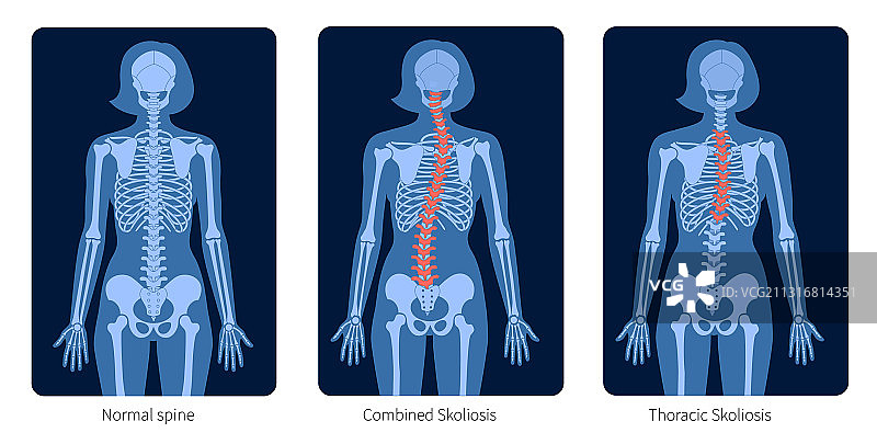 脊椎X光图片素材