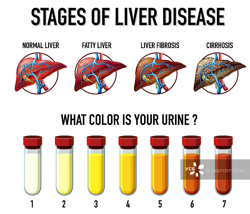 肝脏疾病阶段图片素材