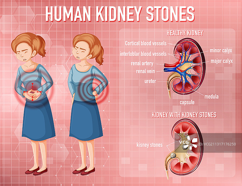 健康肾脏与病变肾脏对比图片素材