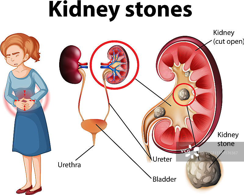 肾结石信息图片素材
