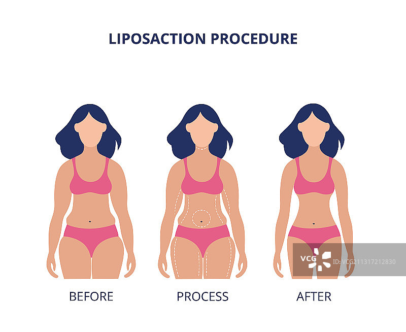 抽脂手术前后对比banner扁平风格图片素材