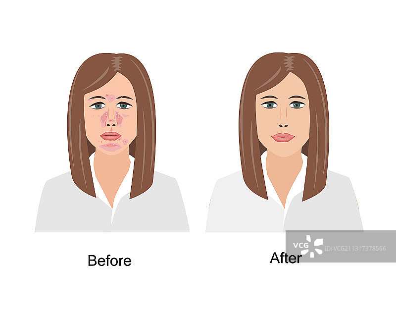 患有脂溢性皮炎的女人图片素材