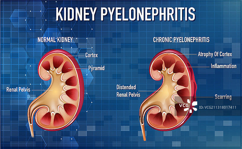 肾盂肾炎科普图片素材