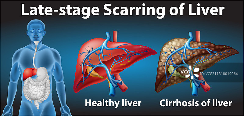 晚期肝脏瘢痕图片素材