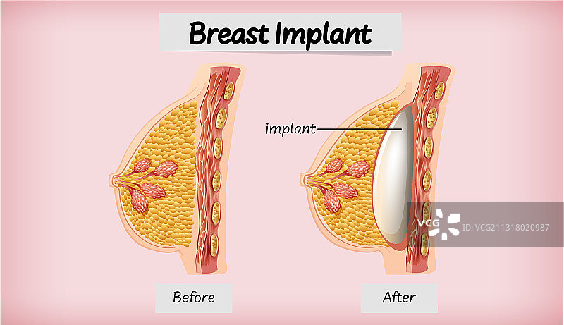 人体乳房植入解剖图图片素材
