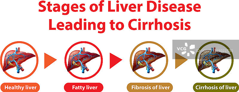 导致肝硬化的肝病阶段图片素材
