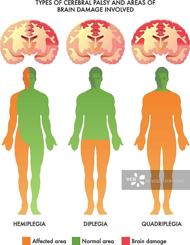 脑瘫脑损伤图片素材