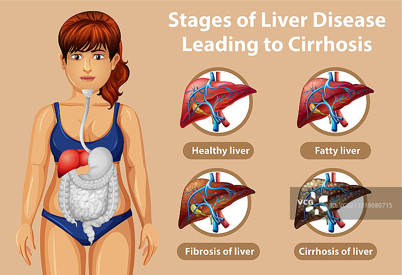导致肝硬化的肝病阶段图片素材