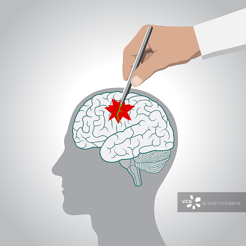 大脑恢复记忆中风概念图片素材