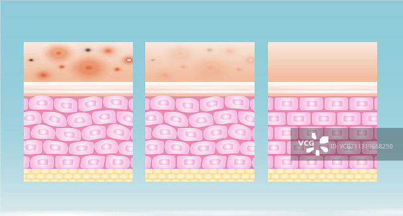 痤疮皮肤斑点问题设计图片素材
