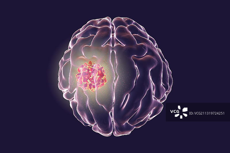 脑癌治疗插画图片素材