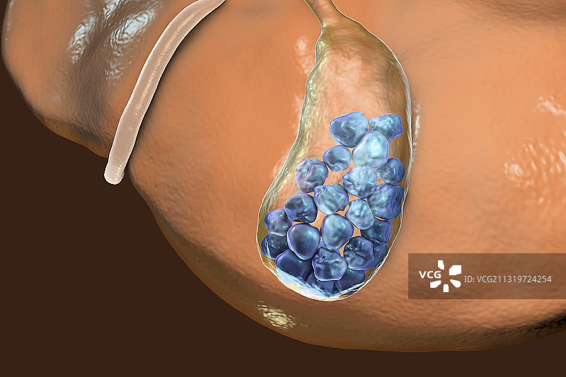 胆结石，艺术作品图片素材