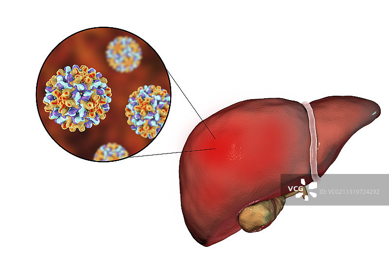 带有乙型肝炎病毒的肝脏，图示图片素材