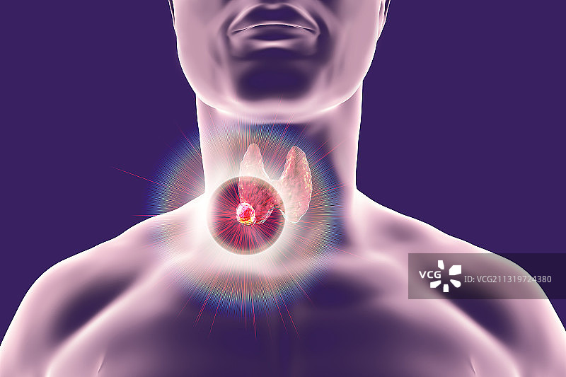甲状腺肿瘤破坏医学插图图片素材
