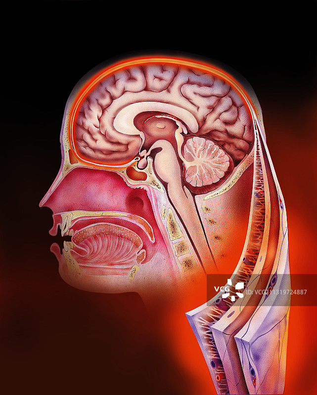 细菌性脑膜炎图片素材