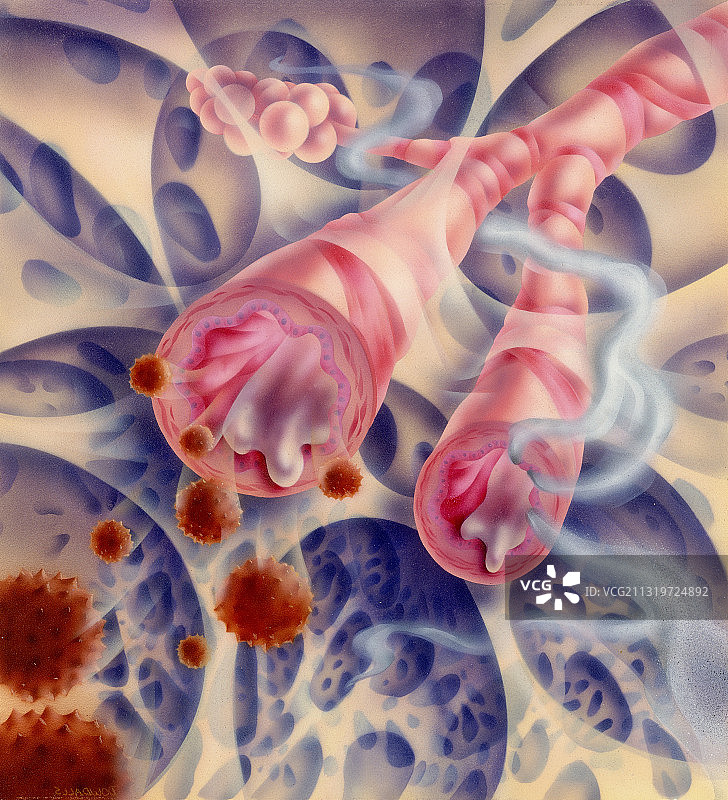 肺气肿图片素材