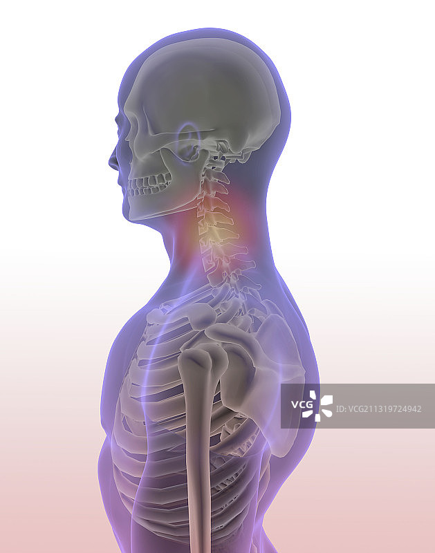 颈部疼痛插图图片素材