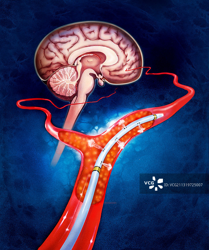 脑血栓治疗插图图片素材