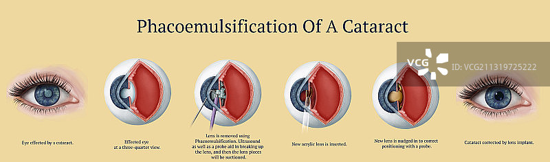白内障手术、插图图片素材