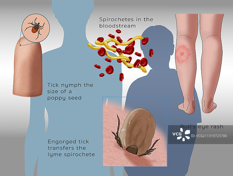 莱姆病感染周期图图片素材