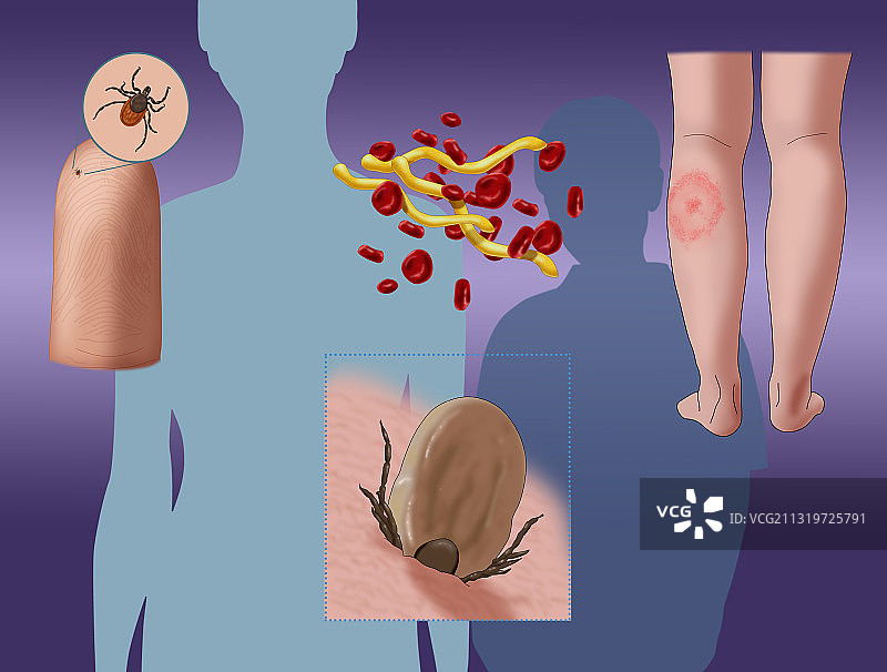 莱姆病感染周期图图片素材