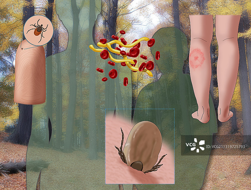 莱姆病感染周期图图片素材