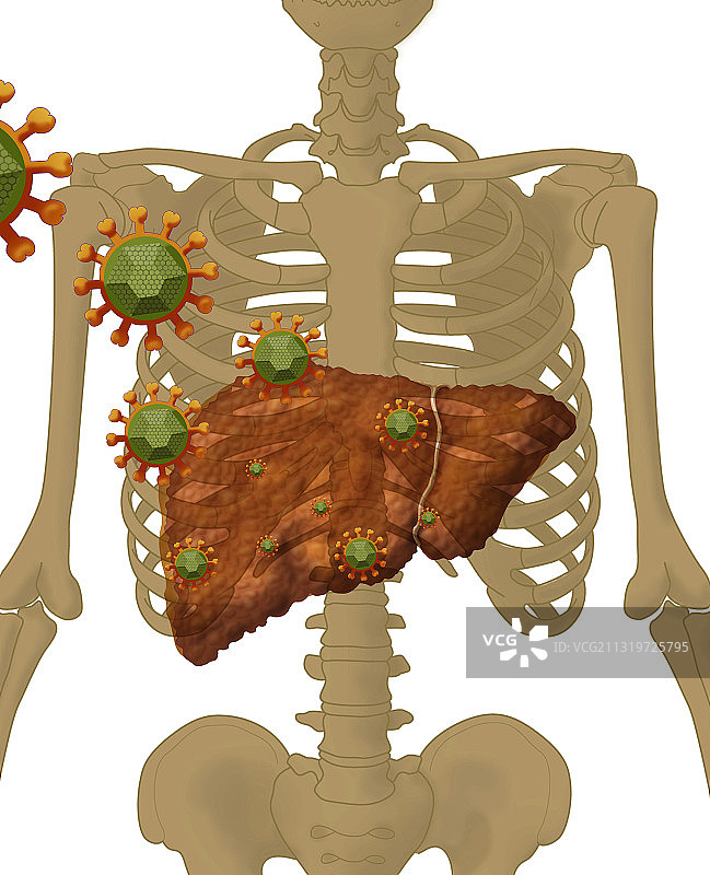 肝炎病毒攻击肝脏图片素材