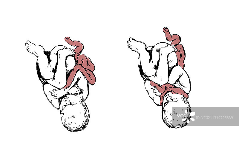 脐带绕颈与出生窒息插图图片素材