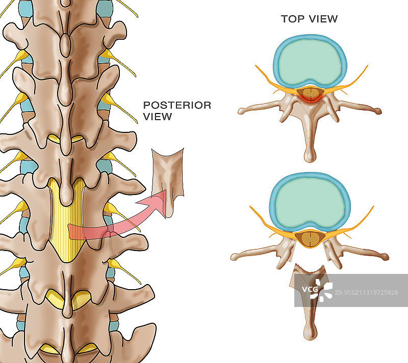 椎板切除术图示图片素材