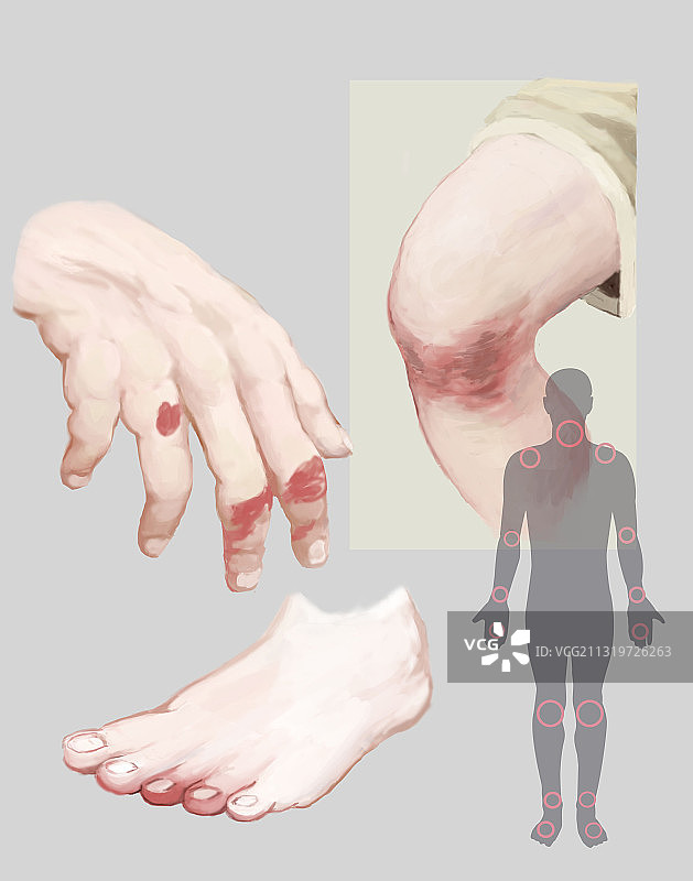 银屑病插图图片素材