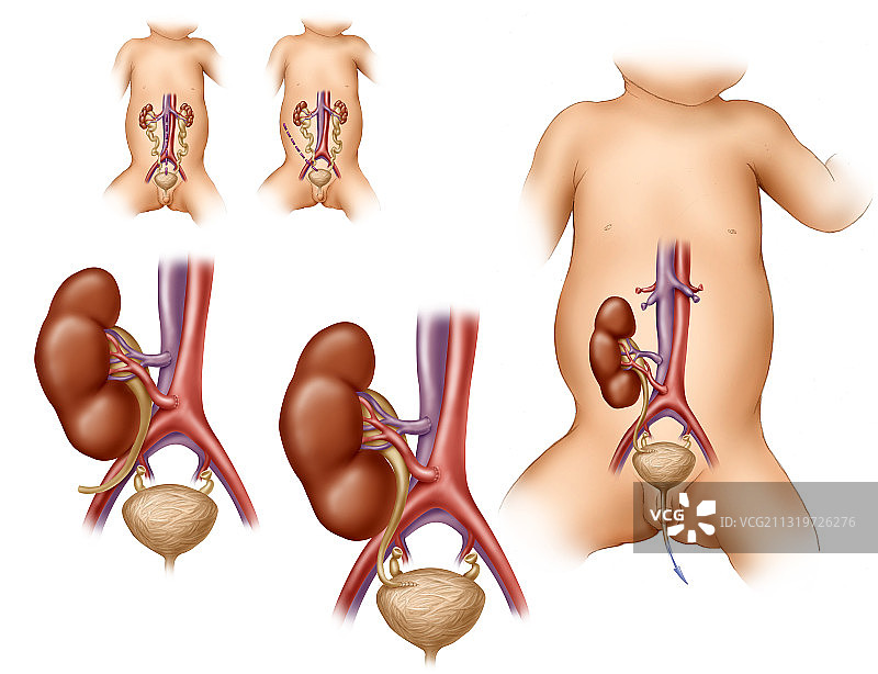 儿童肾移植图片素材