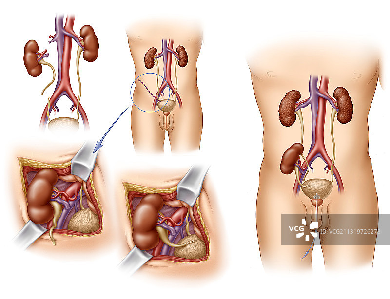 成人肾移植图片素材
