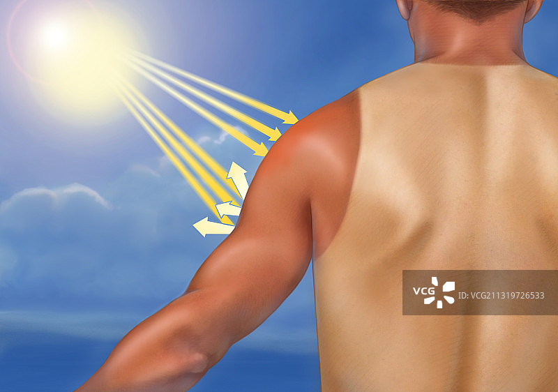 晒伤插画图片素材