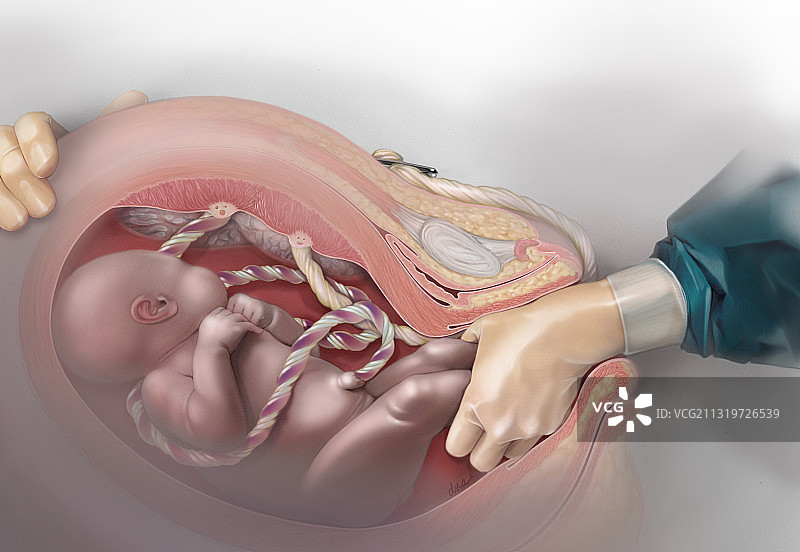 臀位内倒转术助产双胞胎插图图片素材