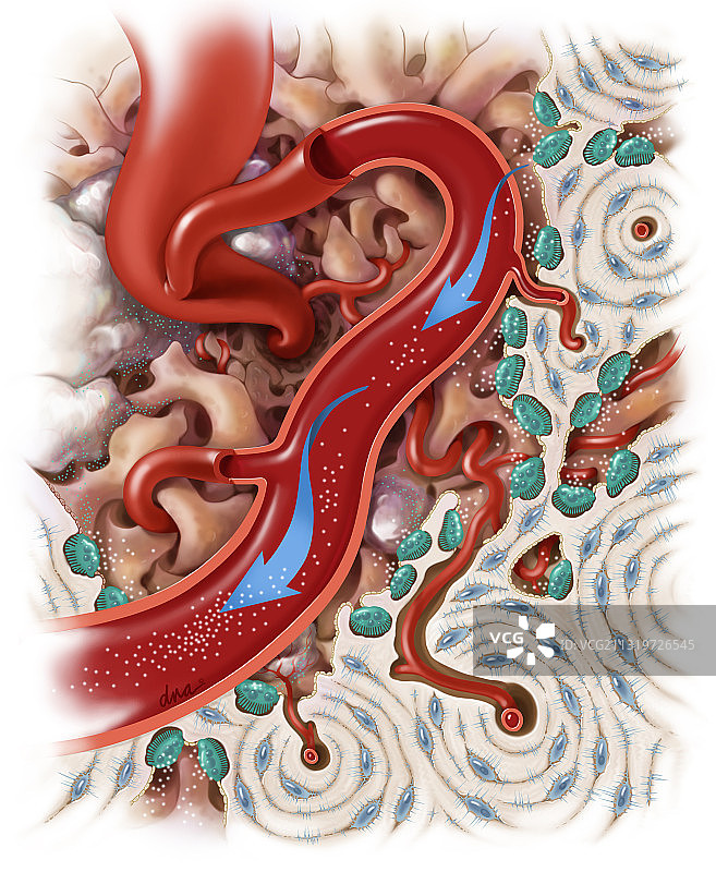 高钙血症图示图片素材