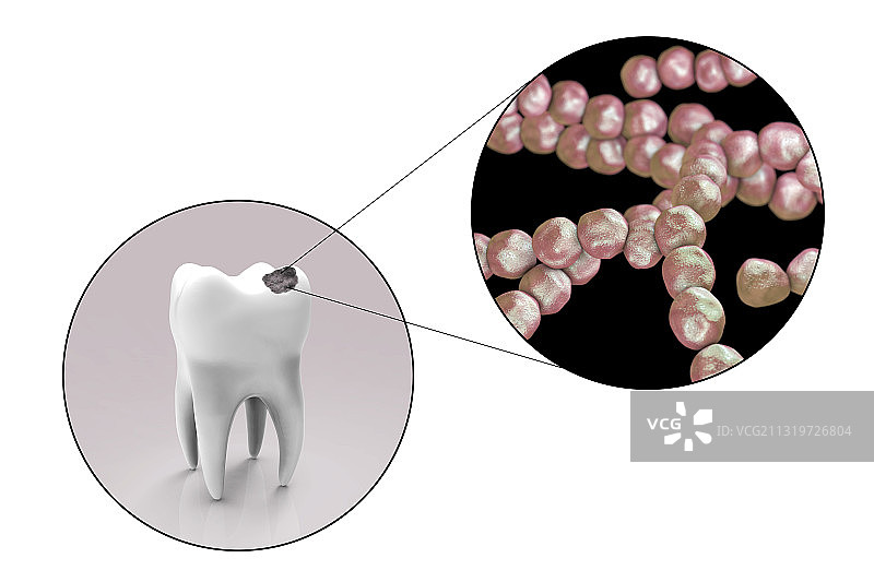 导致龋齿的牙齿腐烂和细菌图片素材