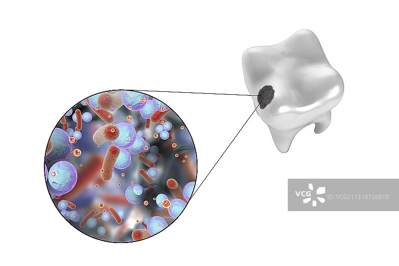 导致龋齿的牙齿腐烂和细菌图片素材